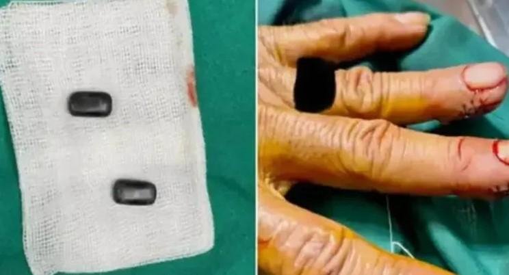 Se implantó imanes en los dedos