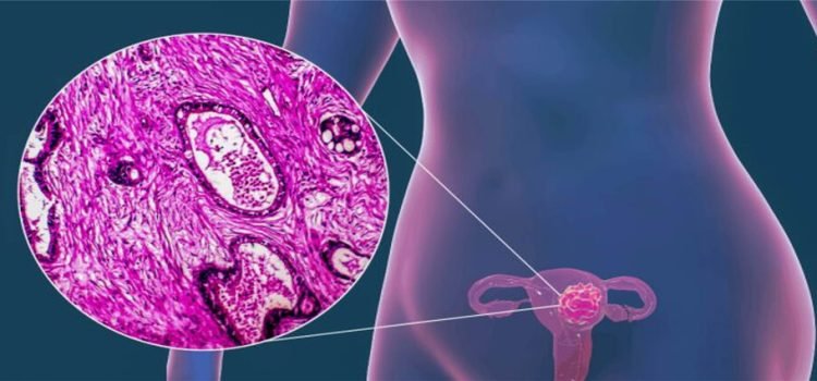 Al alza casos de cáncer cervicouterino en Tijuana