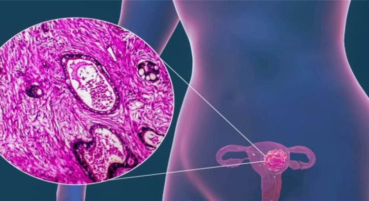 Al alza casos de cáncer cervicouterino en Tijuana