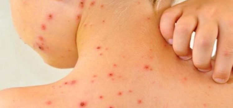 BC entra en alerta por casos de sarampión en Estados Unidos